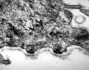  M,7y. | epidermolysis bullosa (dystrophic type) - oral mucosa